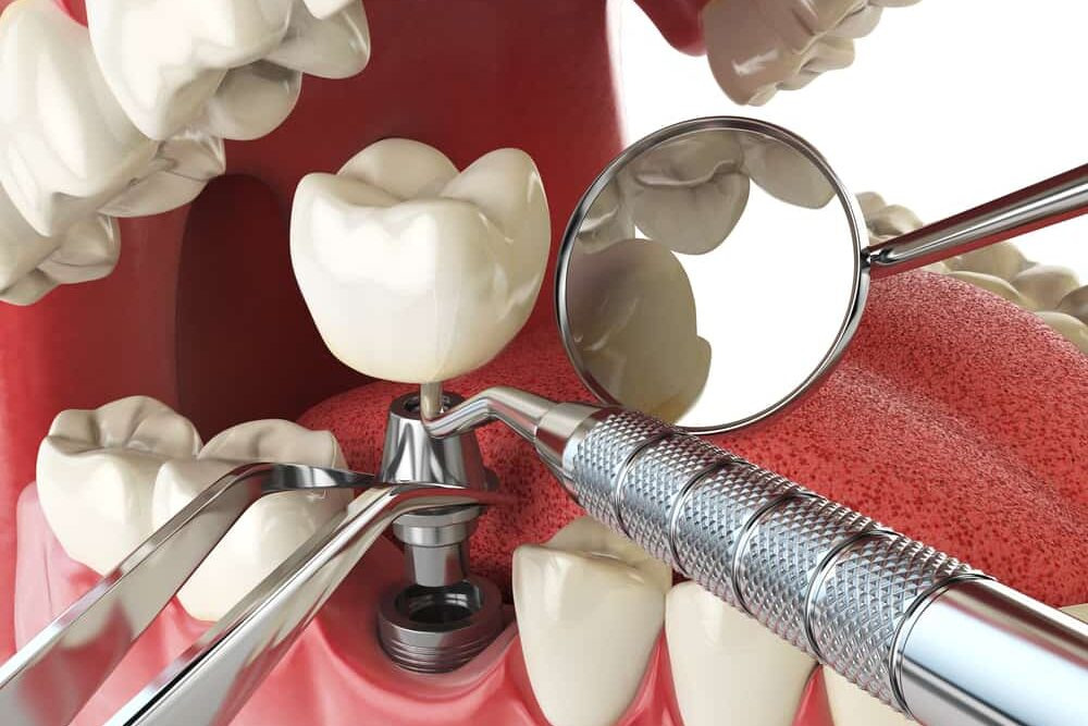 9 Mẹo chữa đau răng sâu cấp tốc, hiệu quả tại nhà